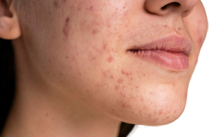 Acne ormonale tardiva femminile: cos’è, quanto dura e rimedi